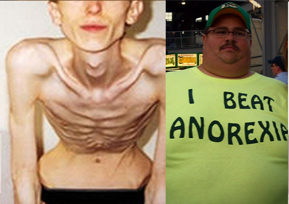 anorexic