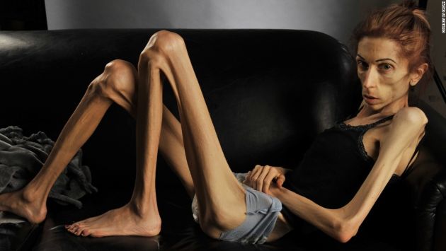 anorexia_nerviosa